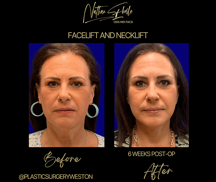 Neck Lift before and after case 2, actual patient at Weston Center for Plastic Surgery