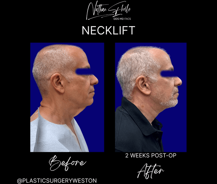 Neck Lift before and after case 24, actual patient at Weston Center for Plastic Surgery