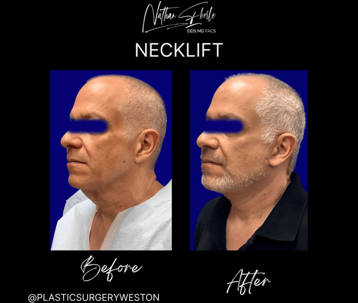 Neck Lift before and after case 25, actual patient at Weston Center for Plastic Surgery