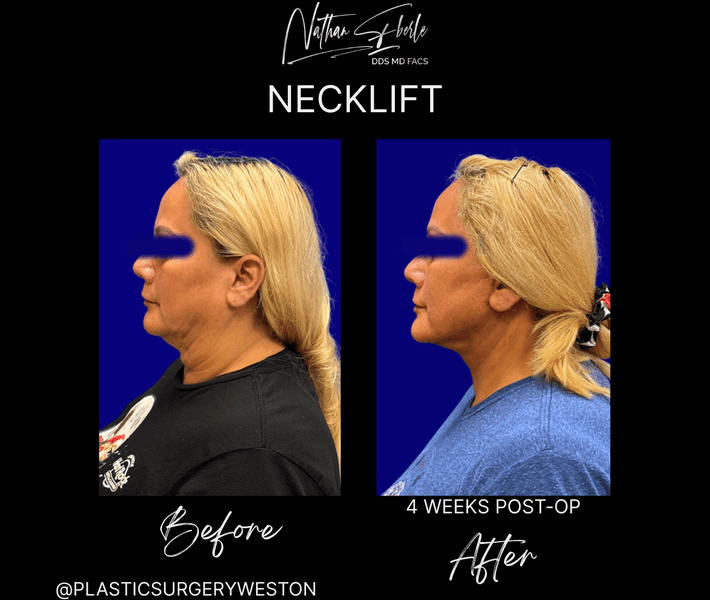 Neck Lift before and after case 26, actual patient at Weston Center for Plastic Surgery
