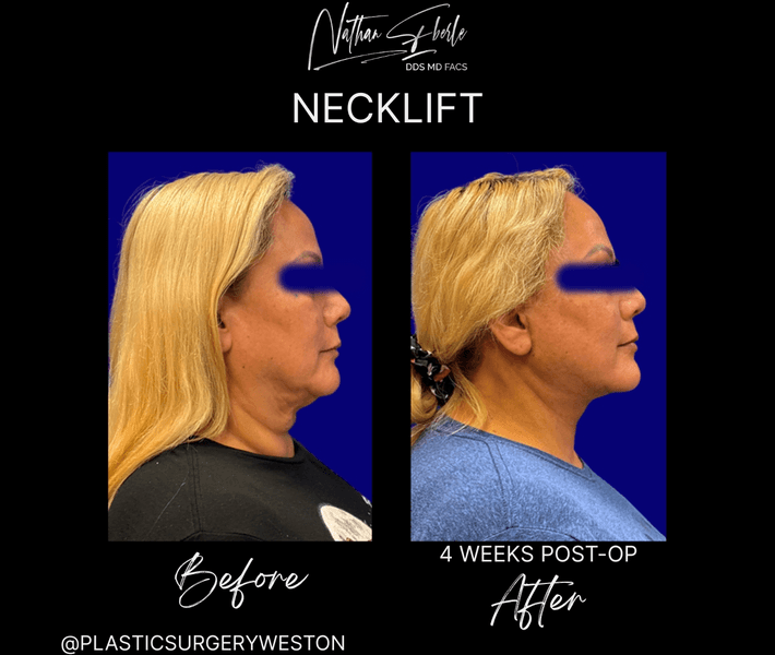 Neck Lift before and after case 27, actual patient at Weston Center for Plastic Surgery