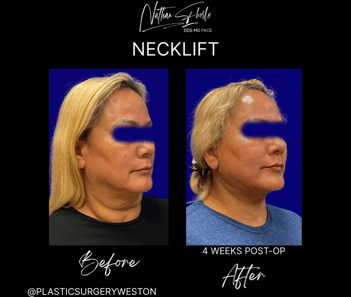 Neck Lift before and after case 28, actual patient at Weston Center for Plastic Surgery