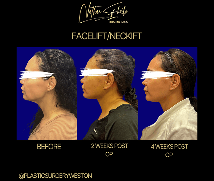 Neck Lift before and after case 3, actual patient at Weston Center for Plastic Surgery