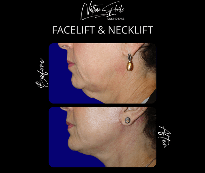 Neck Lift before and after case 5, actual patient at Weston Center for Plastic Surgery