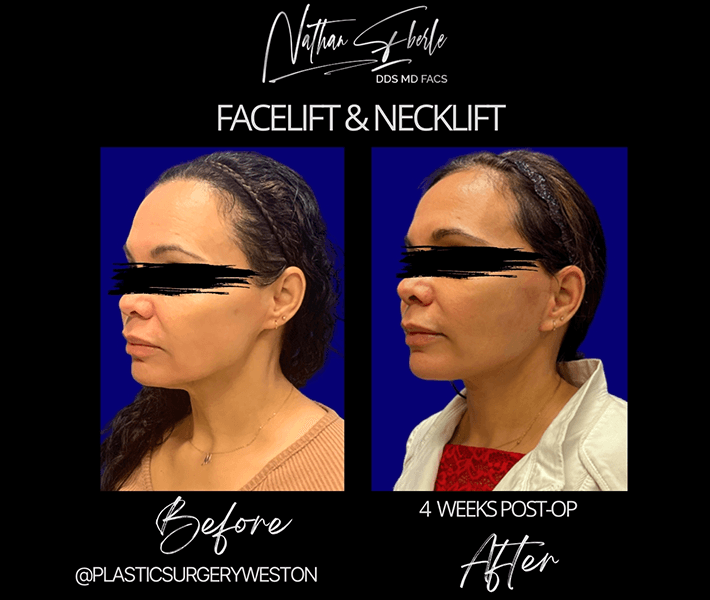 Neck Lift before and after case 9, actual patient at Weston Center for Plastic Surgery