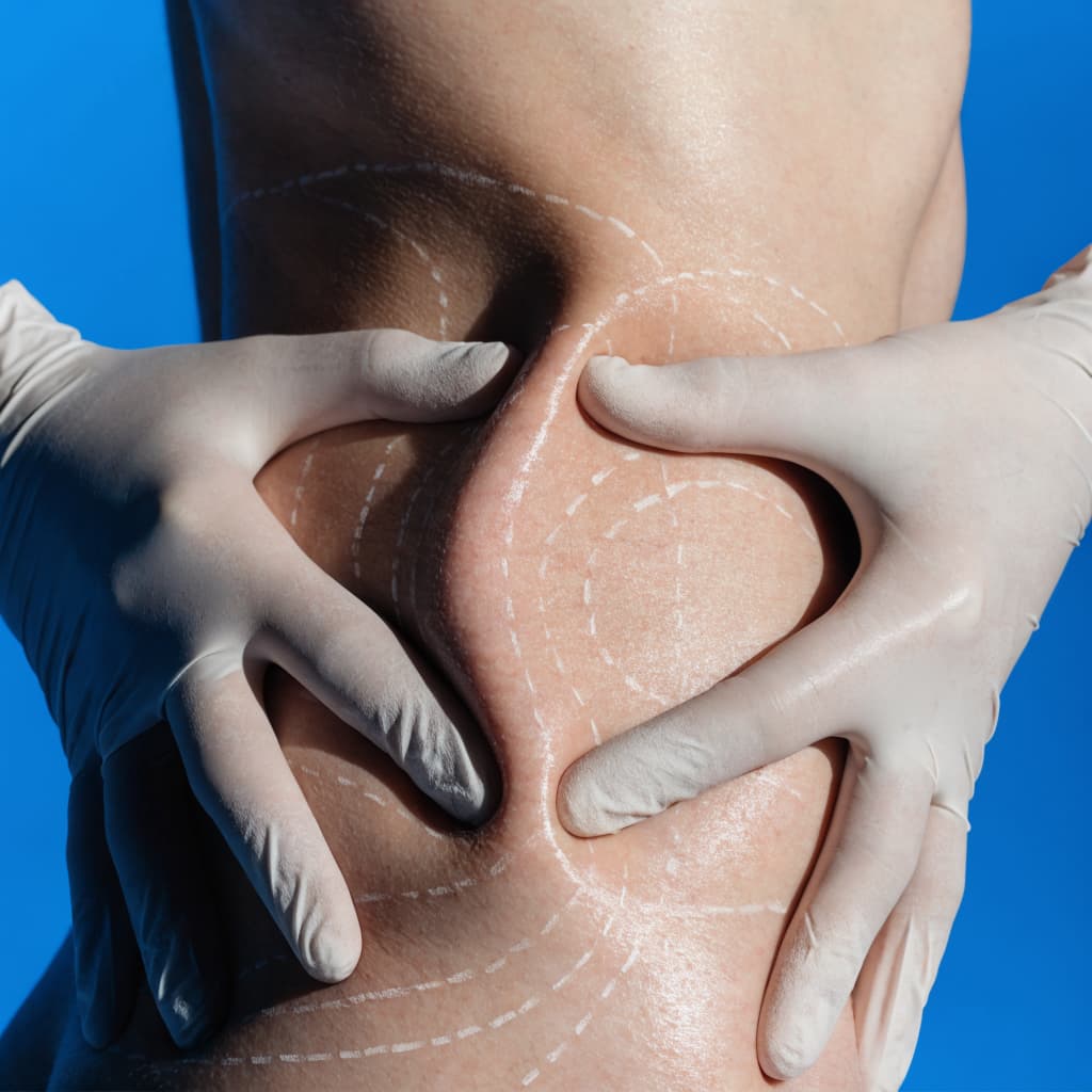 Liposuction