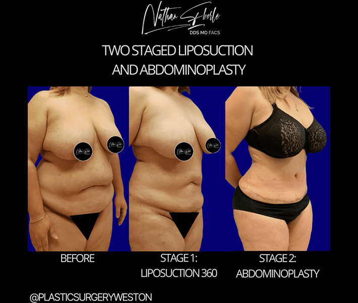 Tummy Tuck before and after case 14, actual patient at Weston Center for Plastic Surgery