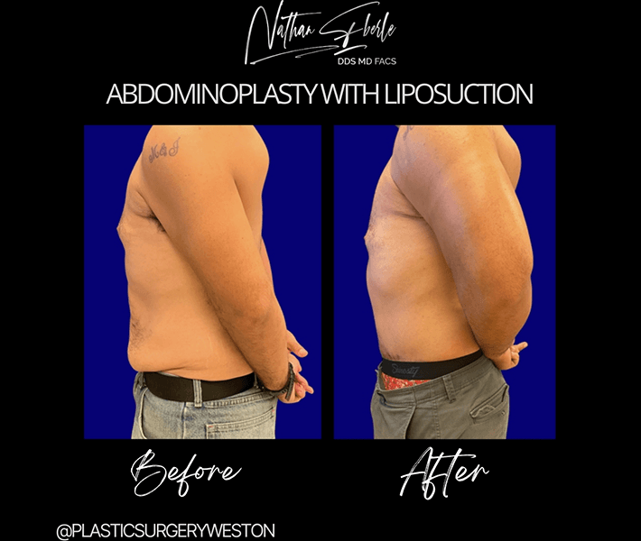 Tummy Tuck before and after case 15, actual patient at Weston Center for Plastic Surgery