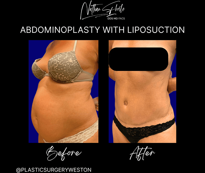 Tummy Tuck before and after case 22, actual patient at Weston Center for Plastic Surgery