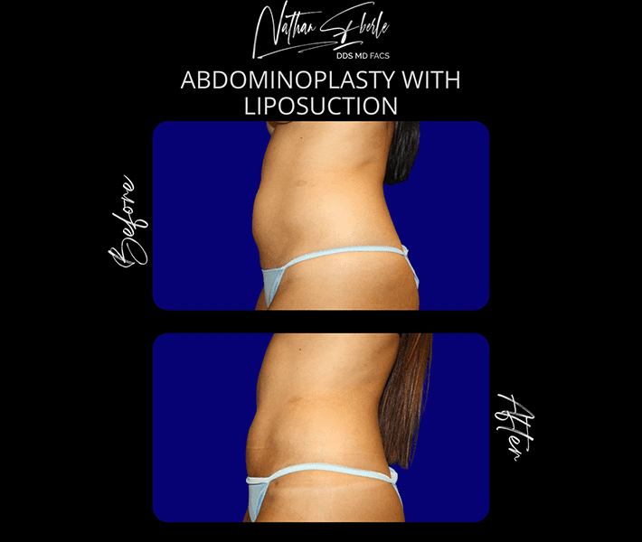 Tummy Tuck before and after case 35, actual patient at Weston Center for Plastic Surgery