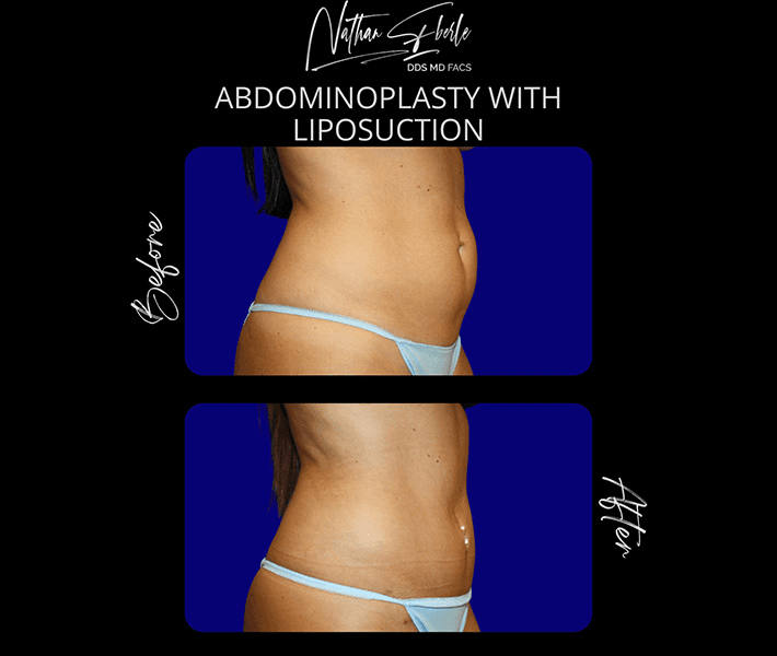 Tummy Tuck before and after case 37, actual patient at Weston Center for Plastic Surgery