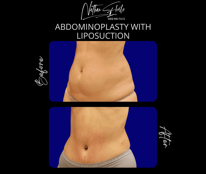 Tummy Tuck before and after case 38, actual patient at Weston Center for Plastic Surgery