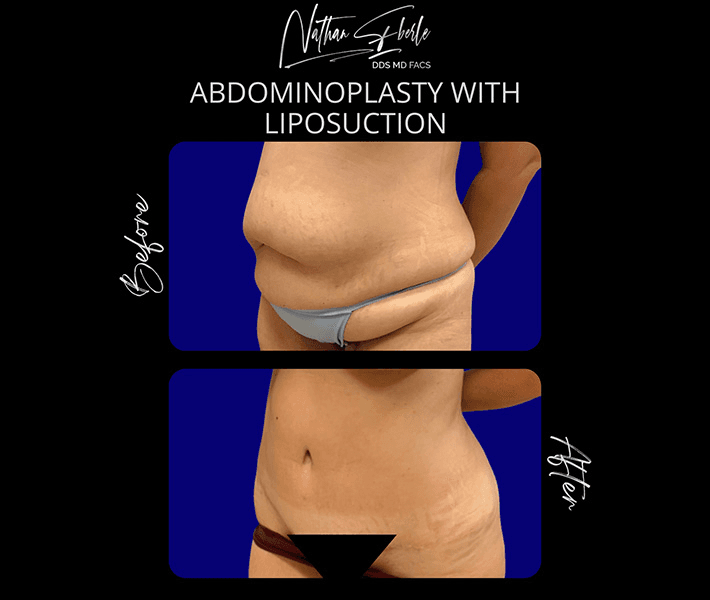 Tummy Tuck before and after case 39, actual patient at Weston Center for Plastic Surgery