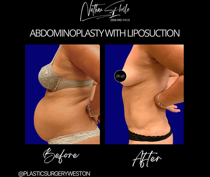Tummy Tuck before and after case 41, actual patient at Weston Center for Plastic Surgery